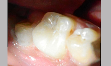 Veneerscrown and bridges treatment in Anand
                        